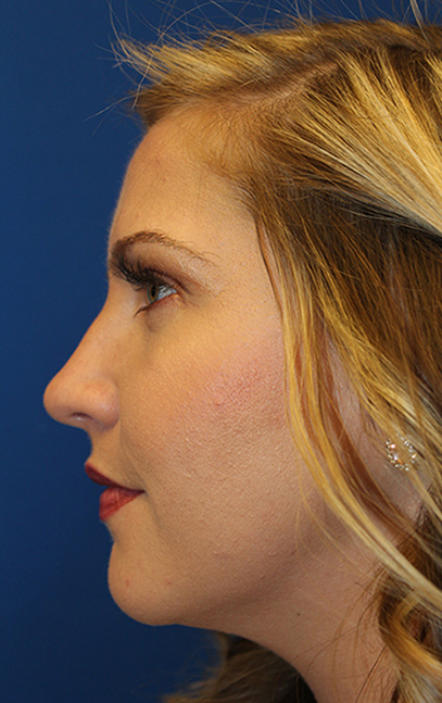 Female Cosmetic Rhinoplasty