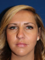 Female Cosmetic Rhinoplasty