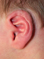 Ear Reshaping