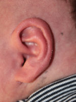 Ear Reshaping