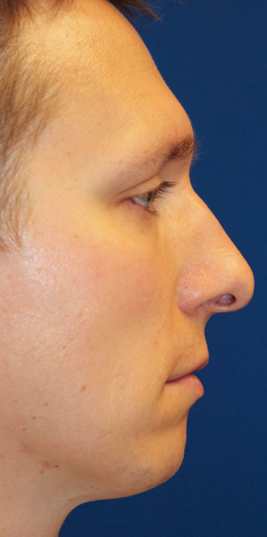 Male Cosmetic Rhinoplasty