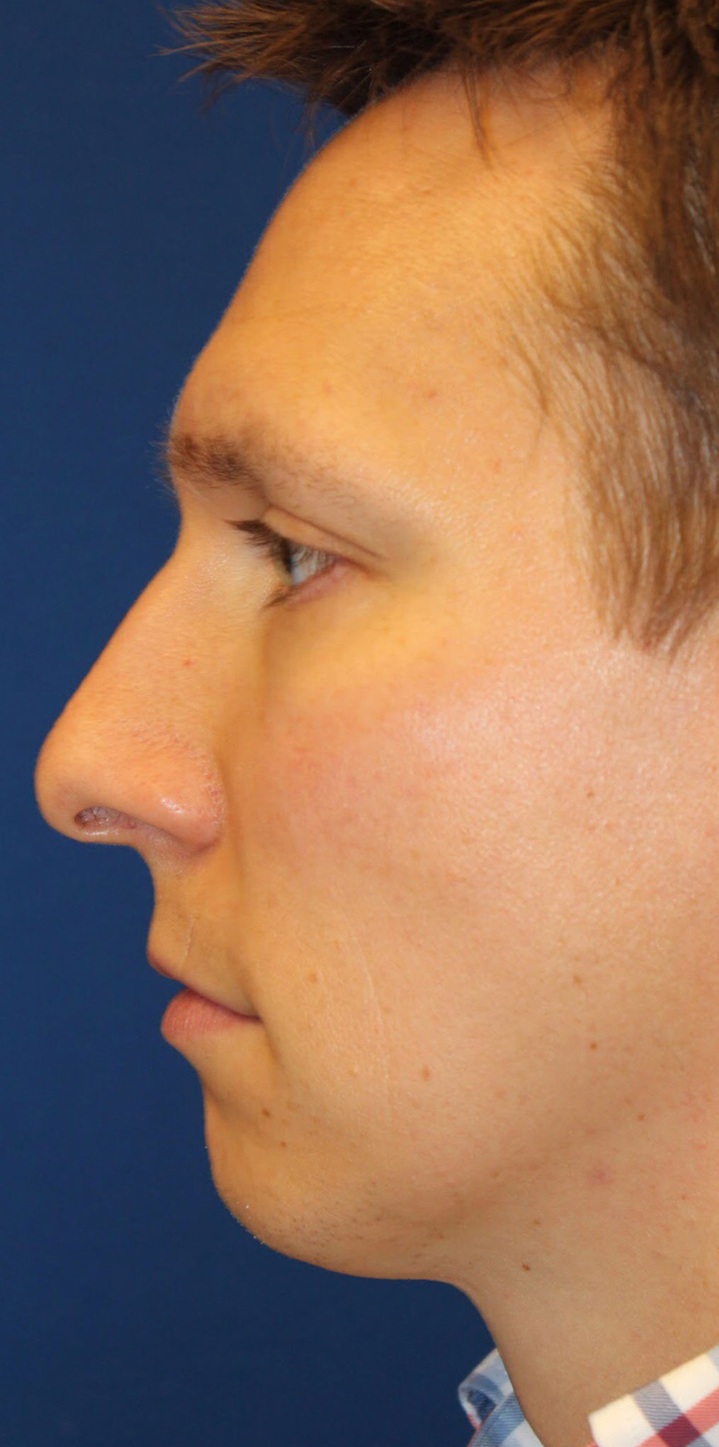 Male Cosmetic Rhinoplasty