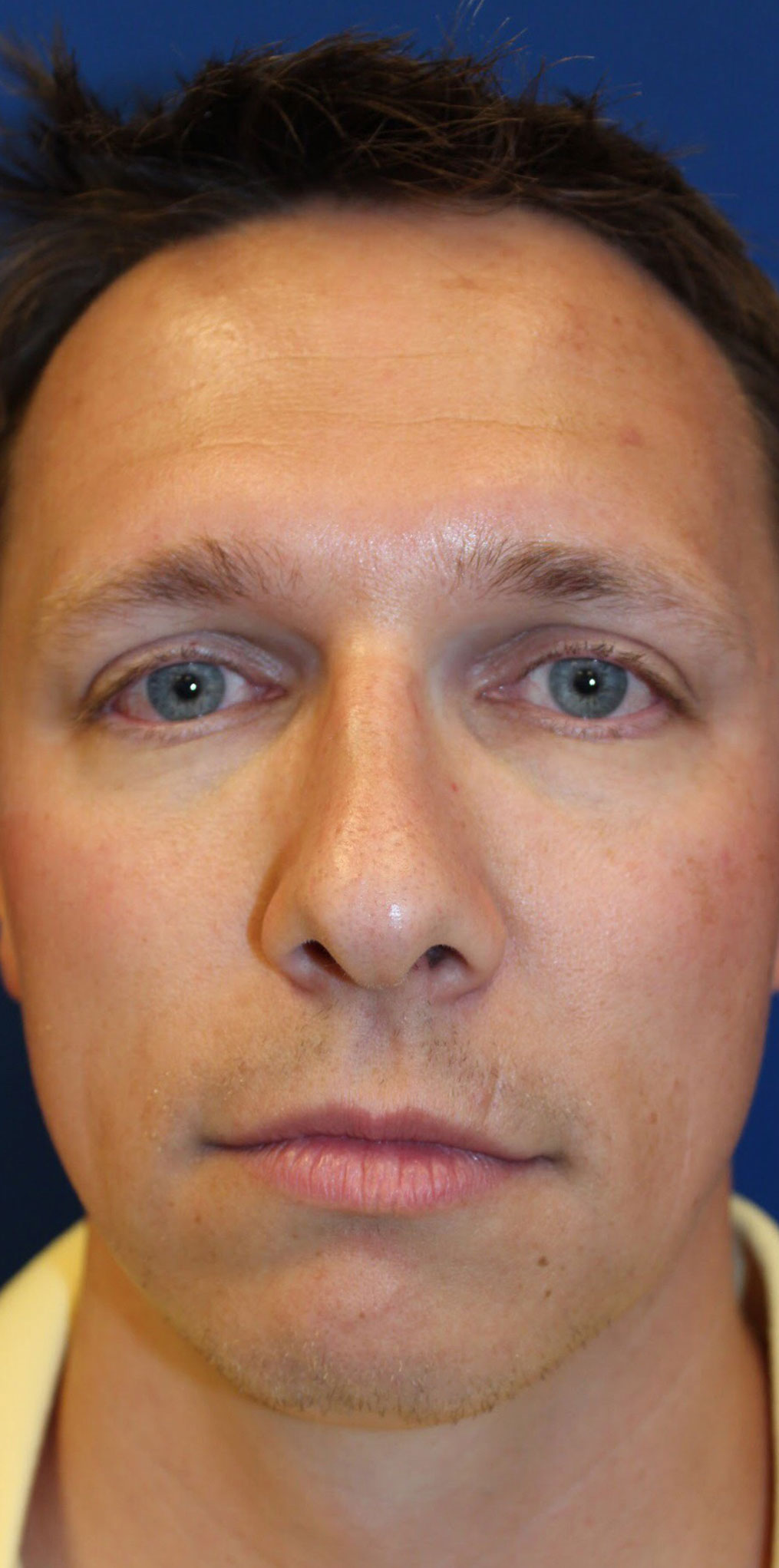 Male Cosmetic Rhinoplasty