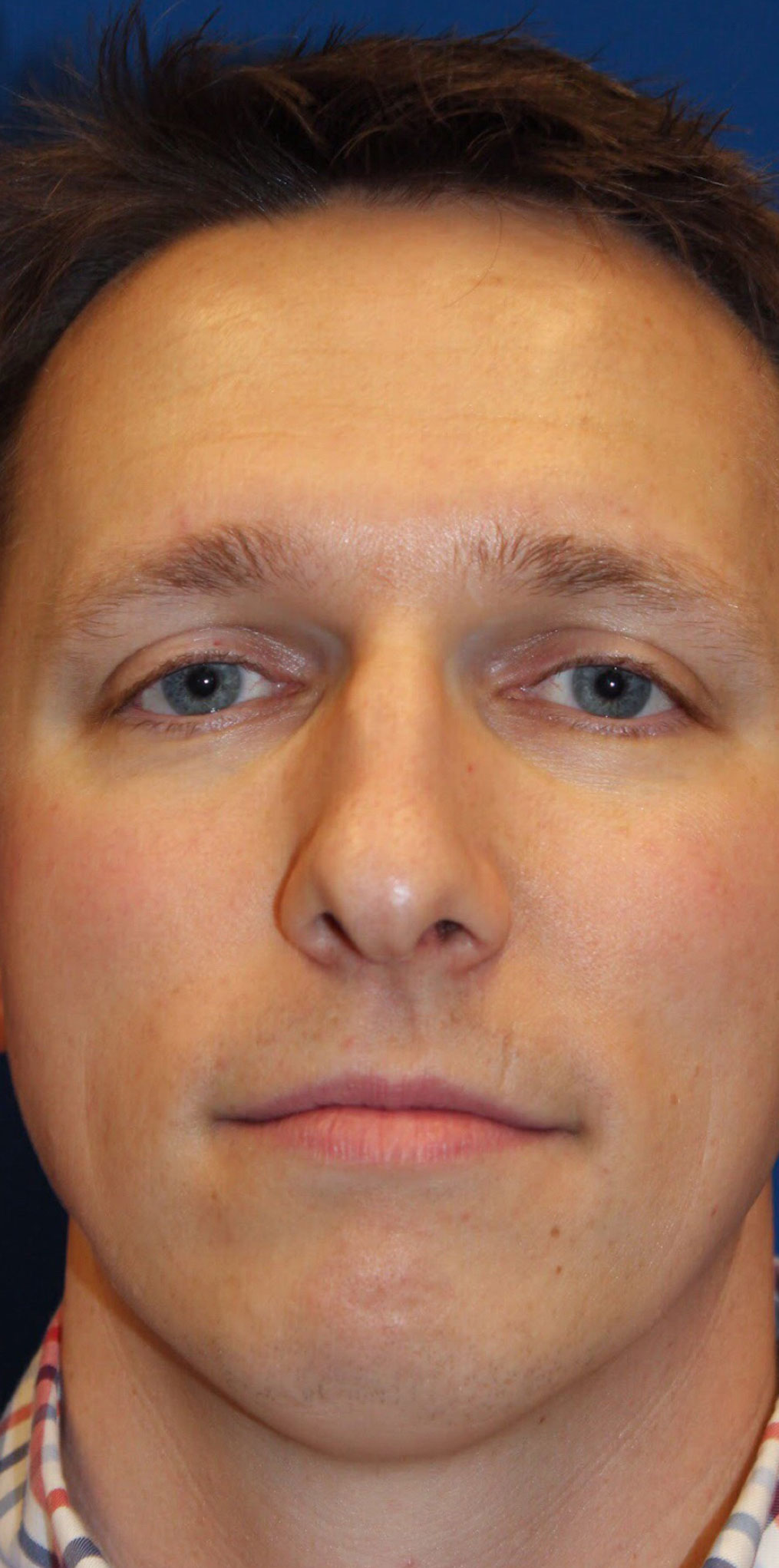 Male Cosmetic Rhinoplasty