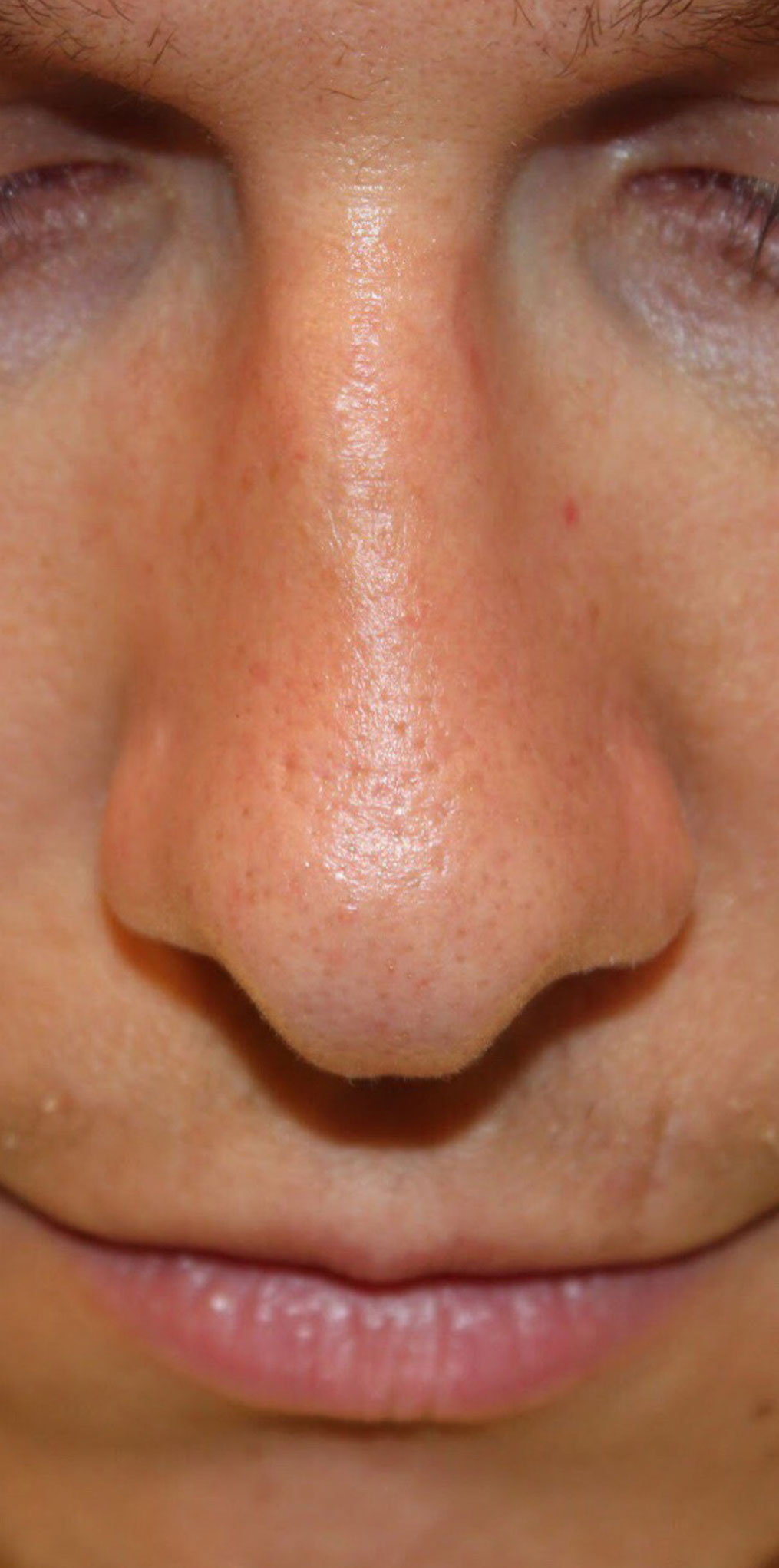 Male Cosmetic Rhinoplasty