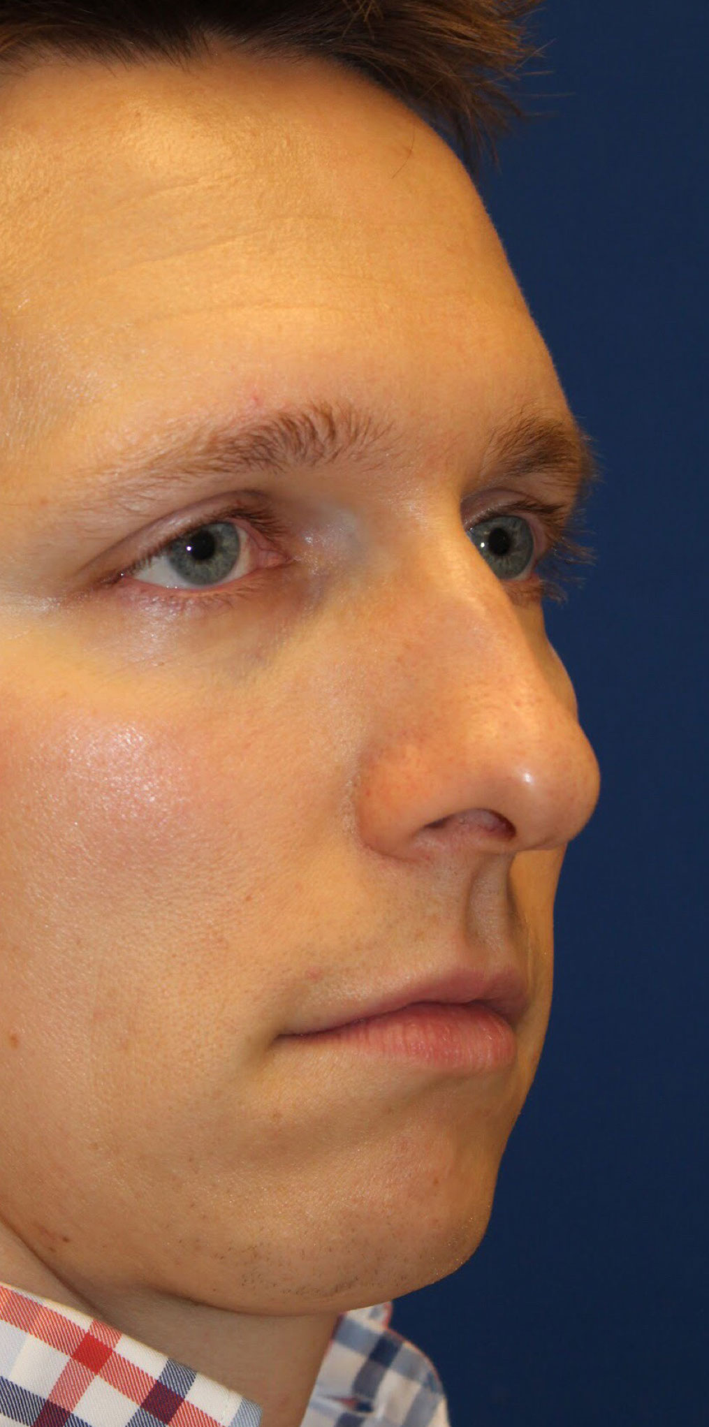 Male Cosmetic Rhinoplasty