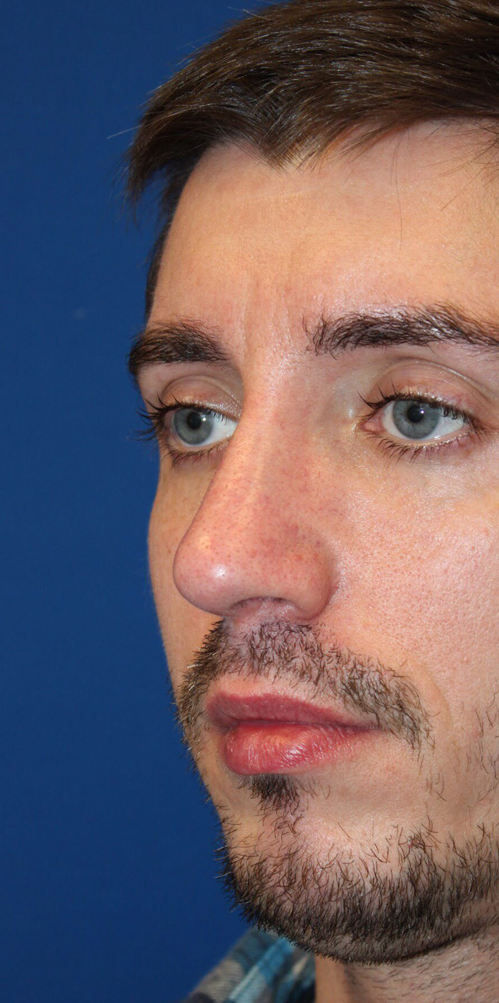 Male Cosmetic Rhinoplasty