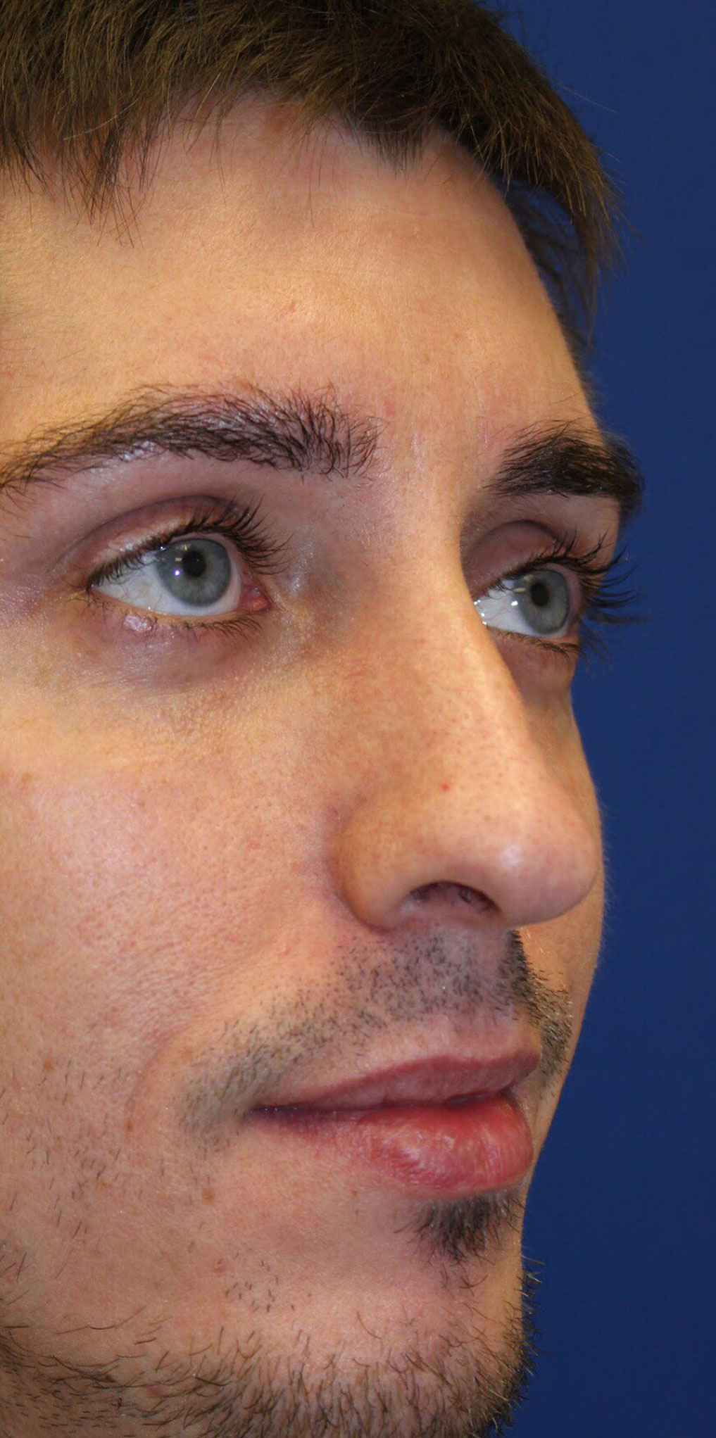 Male Cosmetic Rhinoplasty