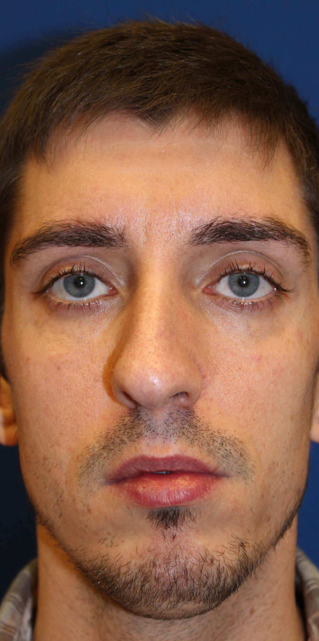 Male Cosmetic Rhinoplasty