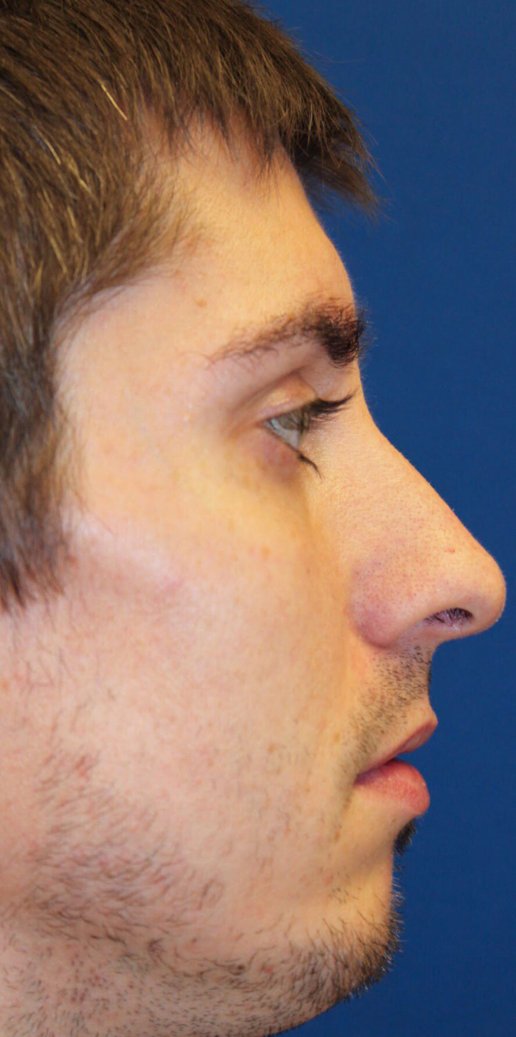 Male Cosmetic Rhinoplasty