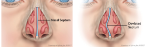 Difference of Nasal septum to Deviated Septum, DEVIATED SEPTUM SURGERY, Troy