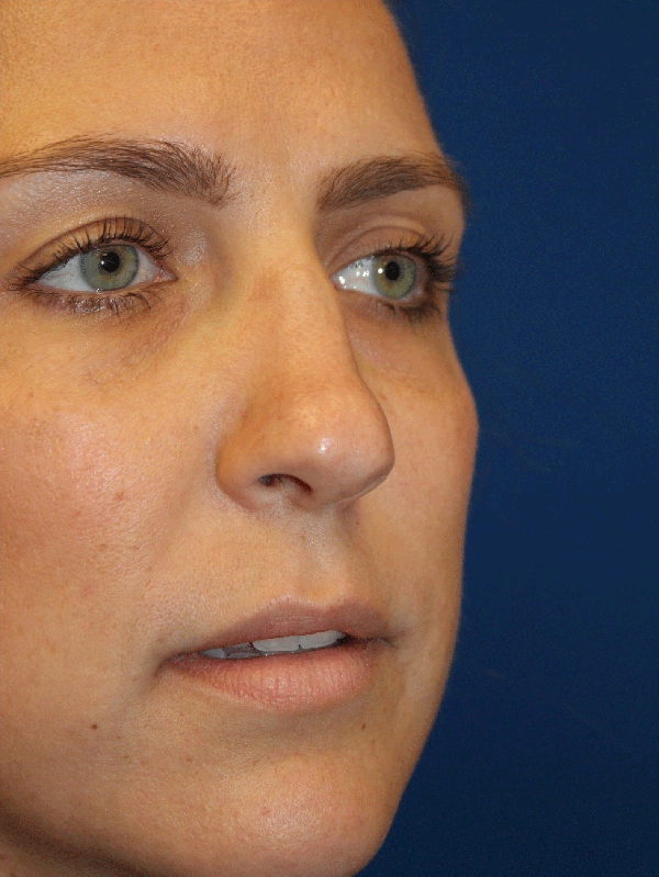 Female Revision Rhinoplasty