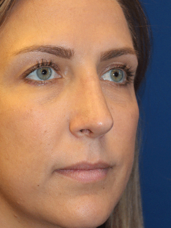 Female Revision Rhinoplasty