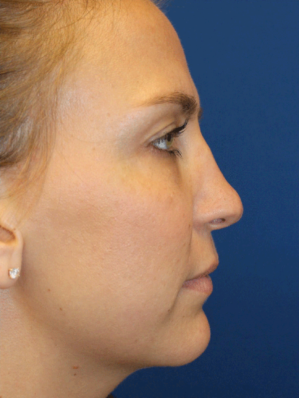 Female Revision Rhinoplasty