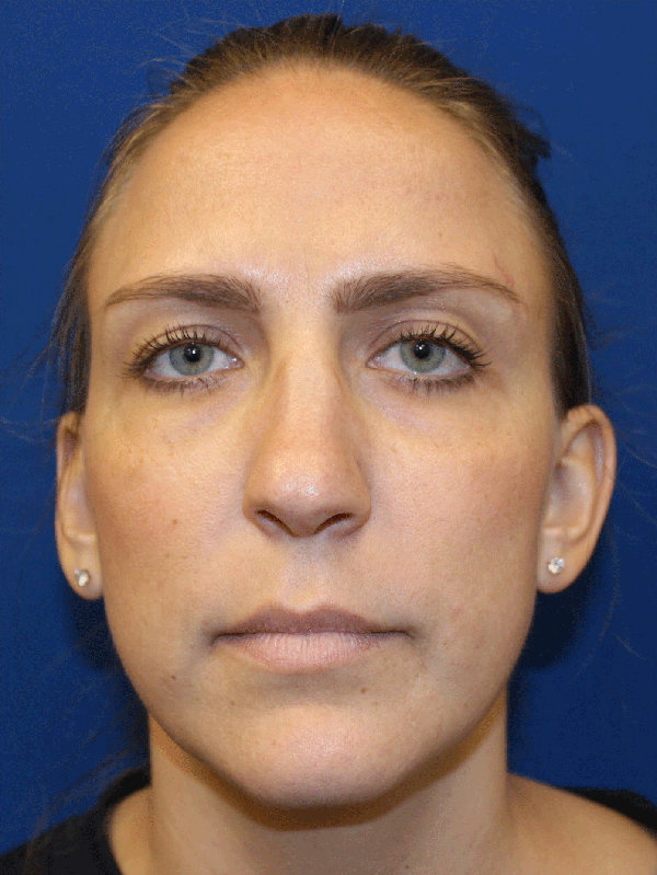 Female Revision Rhinoplasty