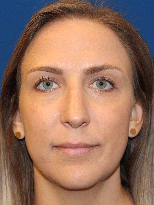 Female Revision Rhinoplasty