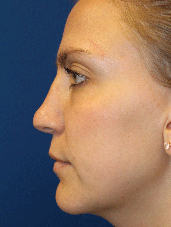 Female Revision Rhinoplasty