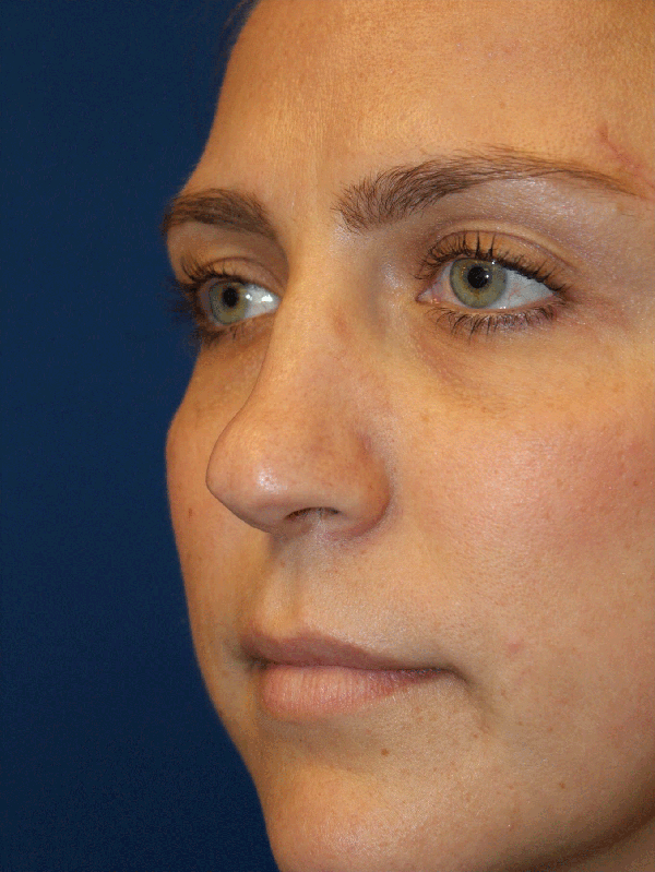 Female Revision Rhinoplasty