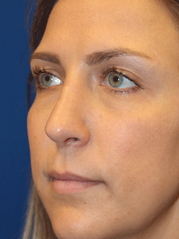 Female Revision Rhinoplasty