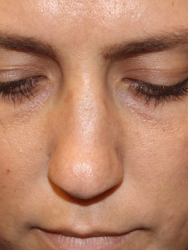 Female Revision Rhinoplasty