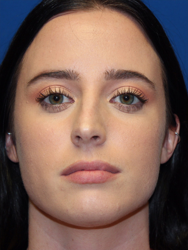 Female Cosmetic Rhinoplasty