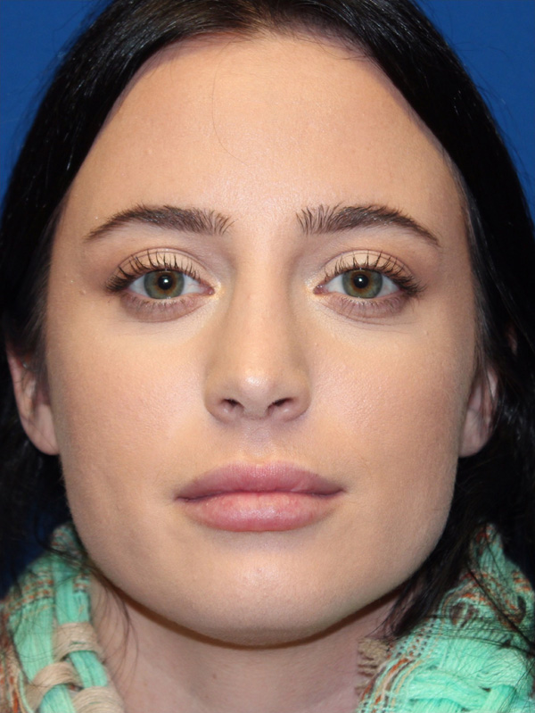 Female Cosmetic Rhinoplasty