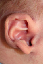 Ear Reshaping