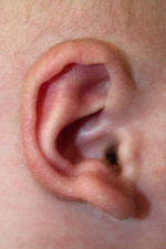 Ear Reshaping