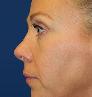 Female Cosmetic Rhinoplasty