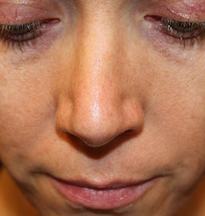 Female Cosmetic Rhinoplasty