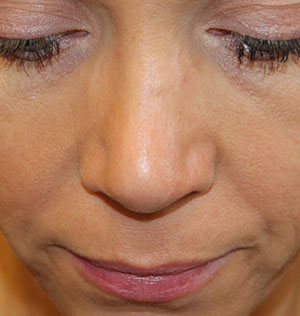 Female Cosmetic Rhinoplasty