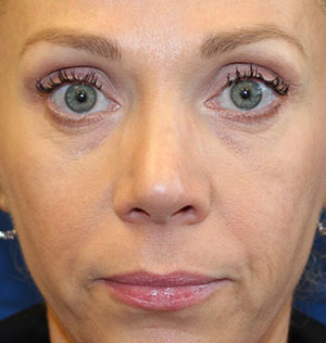 Female Cosmetic Rhinoplasty