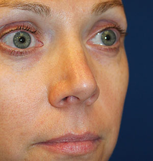 Female Cosmetic Rhinoplasty