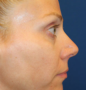 Female Cosmetic Rhinoplasty