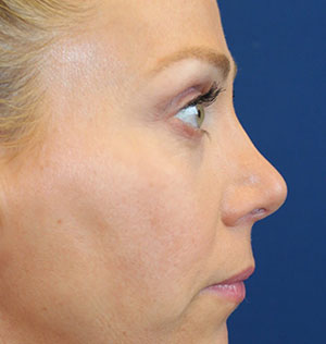 Female Cosmetic Rhinoplasty