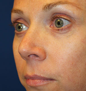 Female Cosmetic Rhinoplasty