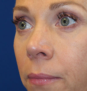 Female Cosmetic Rhinoplasty