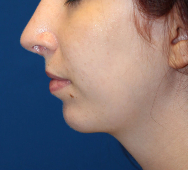 Facial Implants