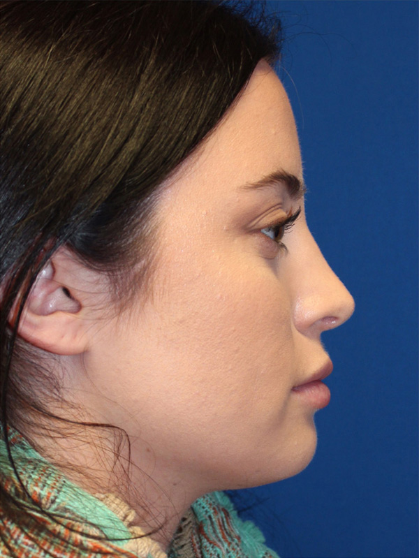 Female Cosmetic Rhinoplasty