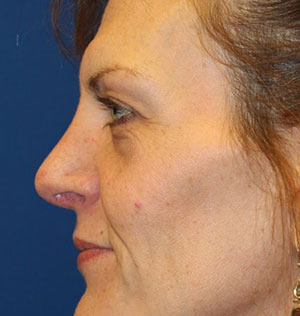 Female Cosmetic Rhinoplasty