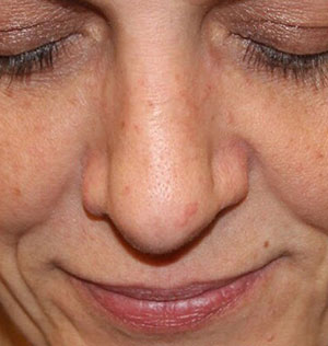 Female Cosmetic Rhinoplasty