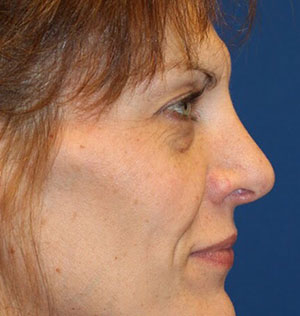 Female Cosmetic Rhinoplasty