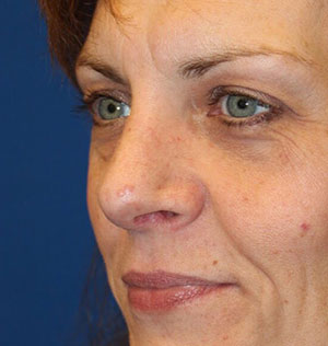 Female Cosmetic Rhinoplasty