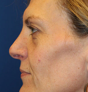 Female Cosmetic Rhinoplasty