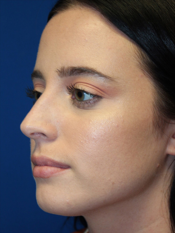 Female Cosmetic Rhinoplasty