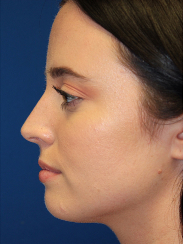 Female Cosmetic Rhinoplasty