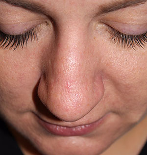 Female Cosmetic Rhinoplasty