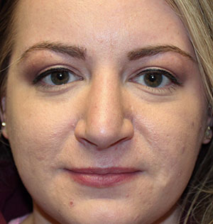 Female Cosmetic Rhinoplasty