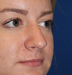 Female Cosmetic Rhinoplasty