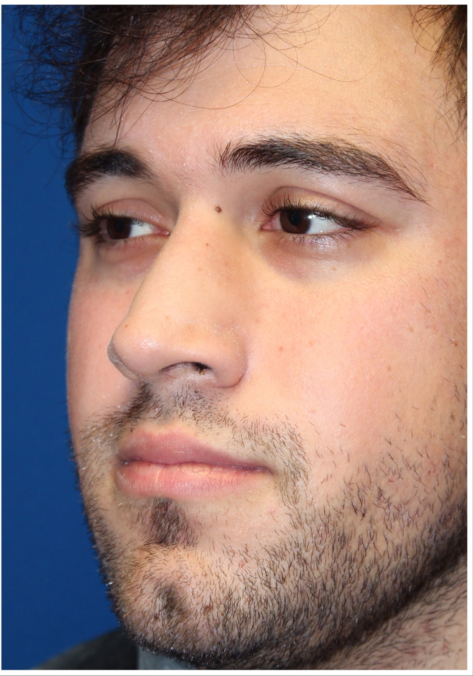 Male Cosmetic Rhinoplasty